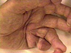 Dupuytren Contracture Severe